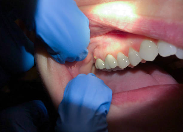 Best Emergency Tooth Extraction  in Jermyn, PA